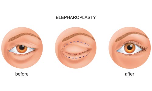 oculoplasty Photo